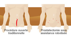 Chirurgie robotique de la prostate